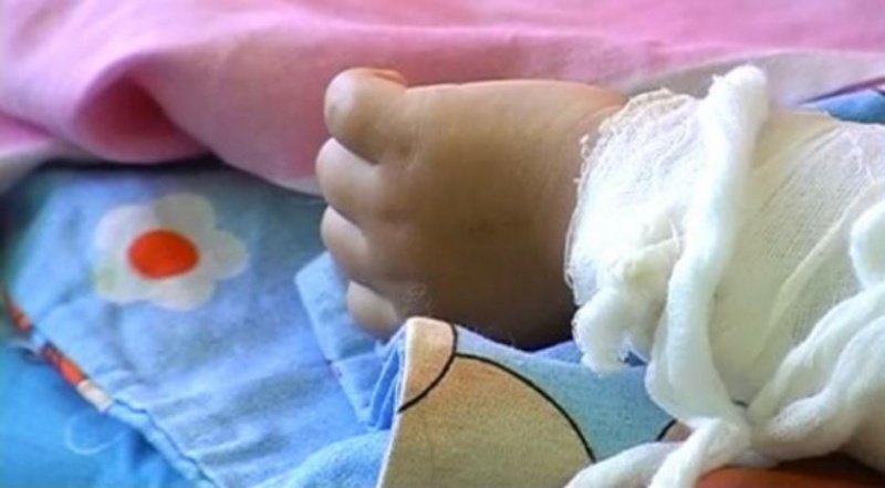 В Оренбурге двухлетнюю девочку с ожогами несколько дней лечили дома