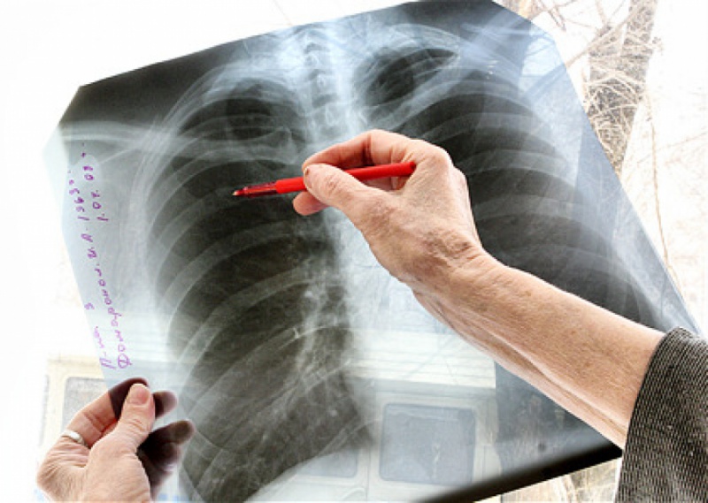 В Орске на 17% снизилась заболеваемость туберкулезом